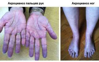 Акроцианоз