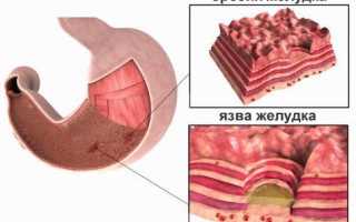 Эрозия желудка