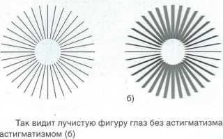 Астигматизм у детей