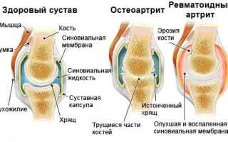 Артрит плечевого сустава