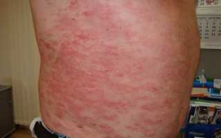 Грибовидный микоз (грибовидная гранулема)