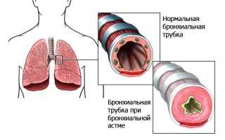 Бронхиальная астма у детей