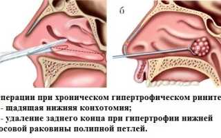 Хронический ринит