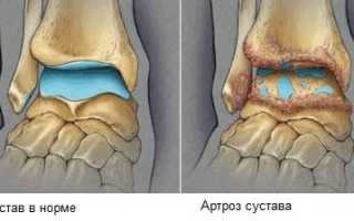 Артроз голеностопного сустава