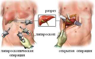 Калькулезный холецистит