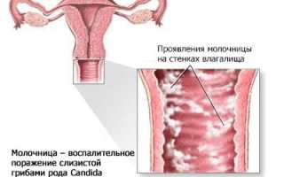 Молочница при беременности