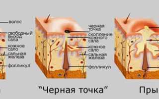 Черные точки на лице — причины появления и как от них избавиться?