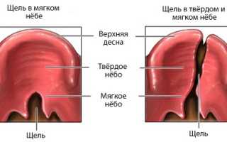 Волчья пасть