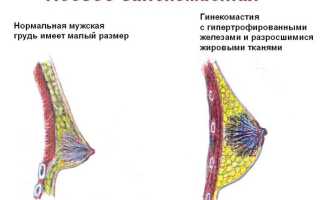 Гинекомастия