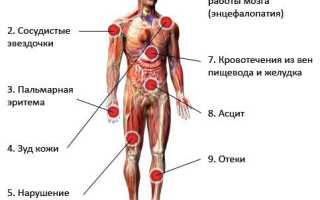 Алкогольный цирроз печени