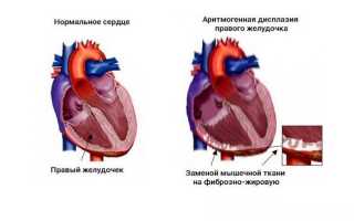 Аритмогенная дисплазия