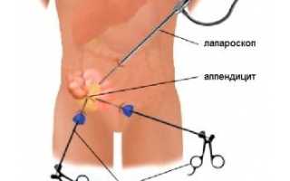 Аппендицит у детей