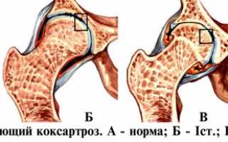 Артроз тазобедренного сустава