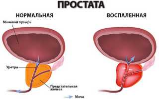 Воспаление простаты