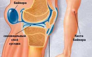 Киста Бейкера