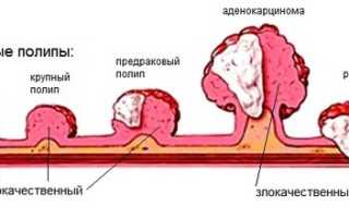 Полипоз