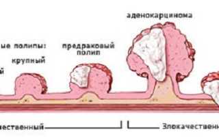 Полипы прямой кишки