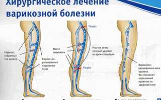 Венозная недостаточность