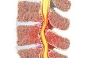 Стеноз позвоночного канала