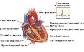 Брадикардия