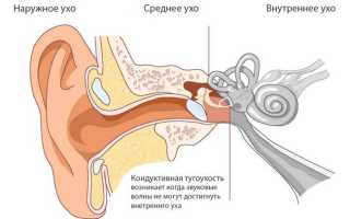 Кондуктивная тугоухость