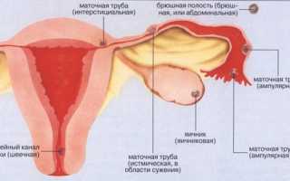 Внематочная беременность