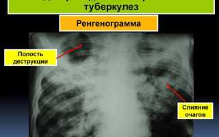 Диссеминированный туберкулез