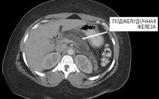 МРТ поджелудочной железы
