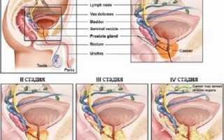 Рак предстательной железы