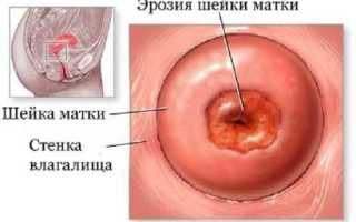 Эрозия шейки матки