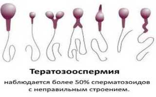Тератозооспермия