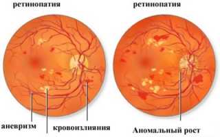 Ретинопатия