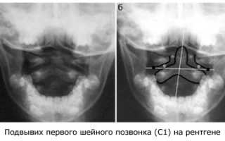 Подвывих шейного позвонка