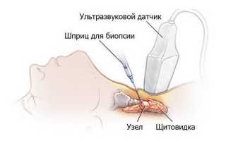 Эндемический зоб