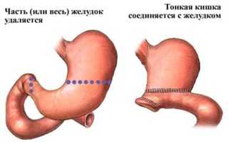 Опухоль желудка