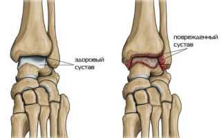 Остеоартроз голеностопного сустава