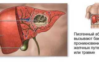 Абсцесс печени