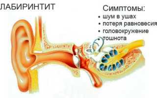 Лабиринтит